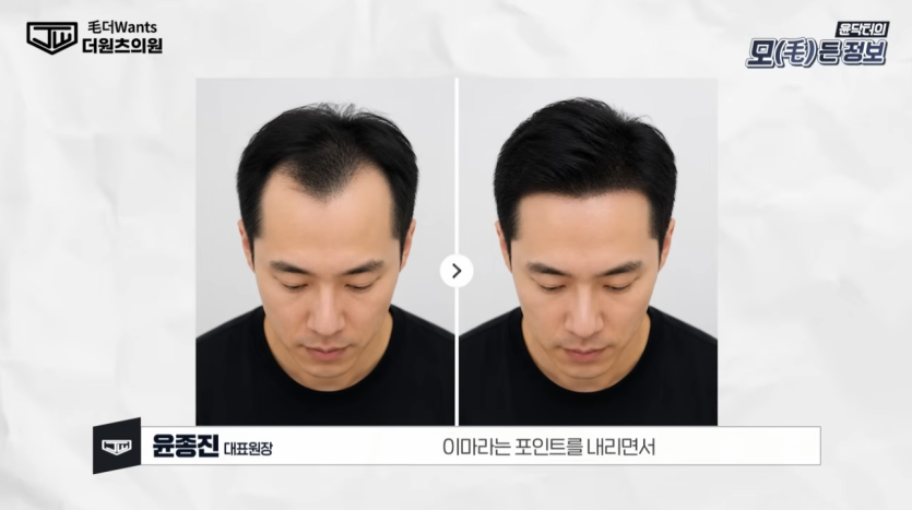 헤어라인 모발이식 전후 비교 모습