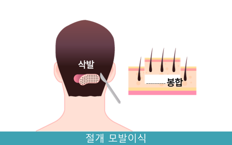 절개 모발이식을 설명하는 그림