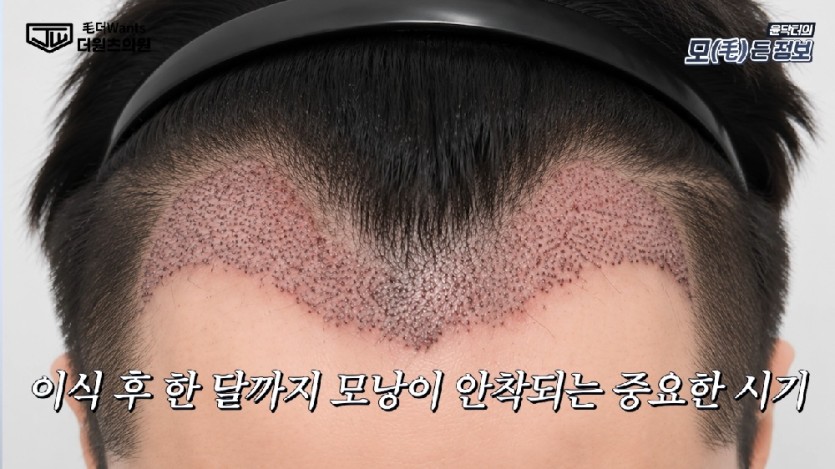 모발이식 후 모습
