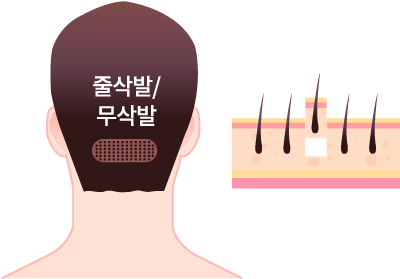 비절개법(FUE) 채취 과정을 보여주는 일러스트 - 줄삭발/무삭발, 펀치로 모낭 단위 채취