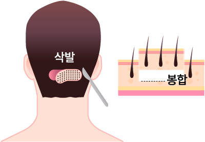 절개법(FUSS) 채취 및 봉합 과정을 보여주는 일러스트 - 삭발 후 띠 모양 채취, 봉합